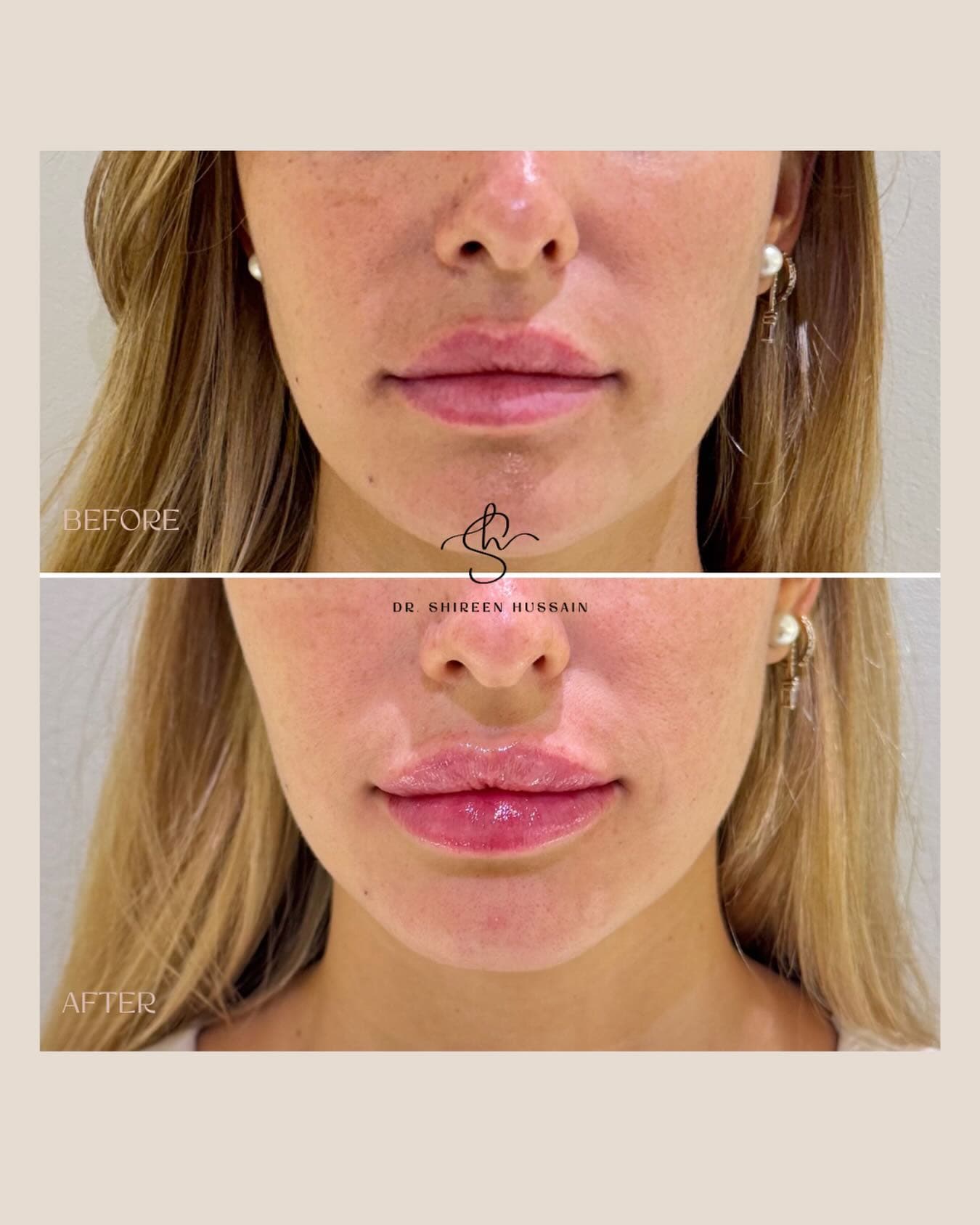 Lip Filler before and after