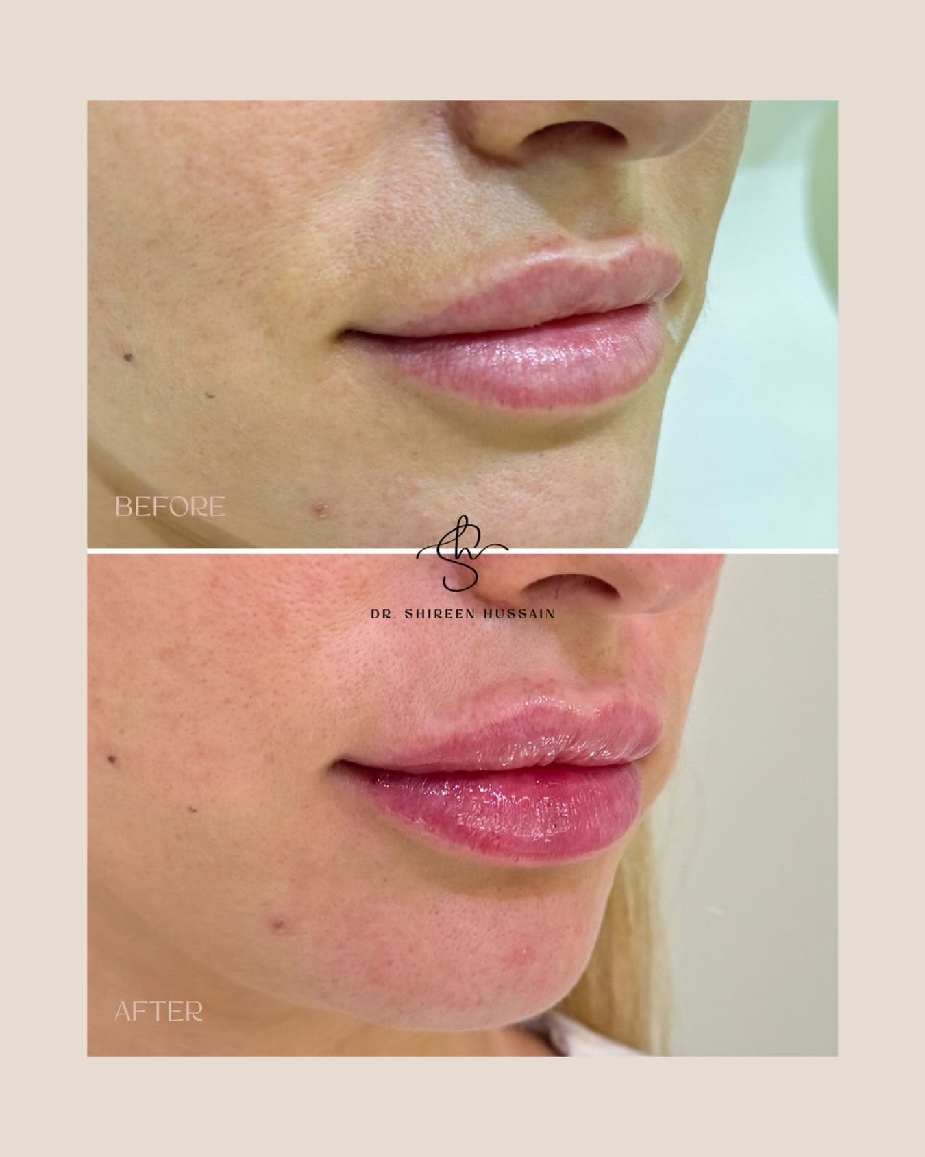 Lip Filler Refresh before and after