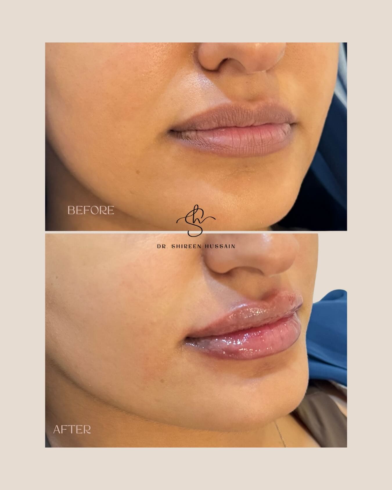 Lip Booster before and after