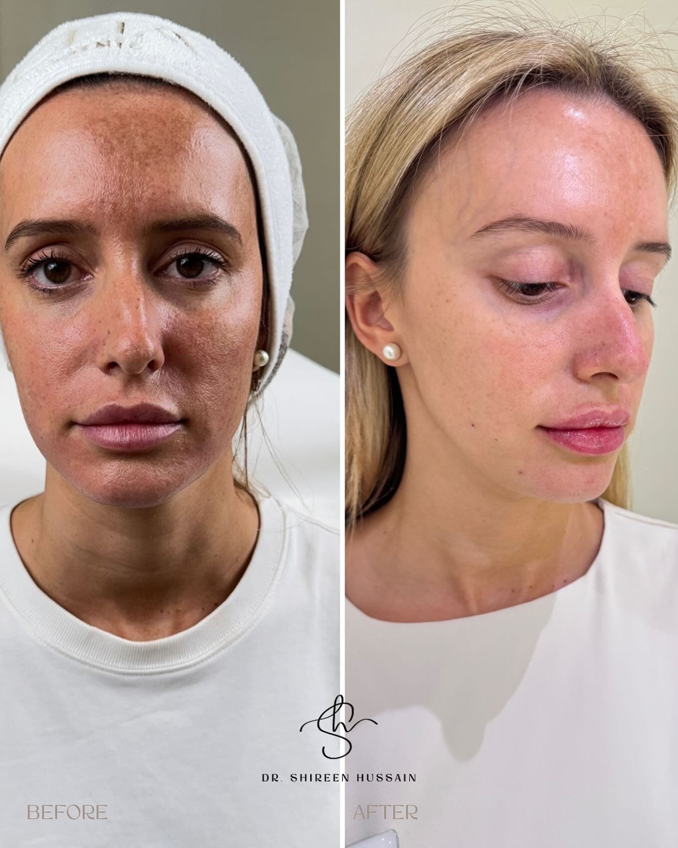 Sun Damage, Ultra Clear Laser before and after